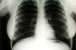 Свердловчанам покажут рентгенограммы легких известных уральцев